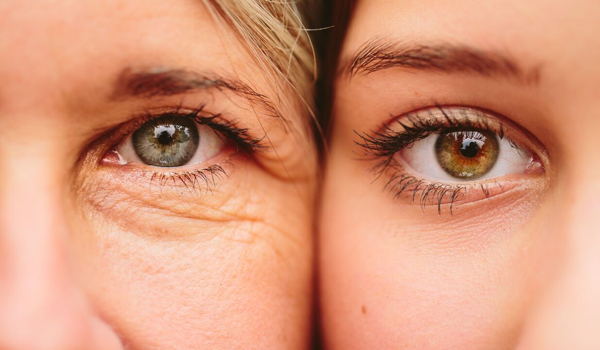မျက်လုံးတစ်ဝိုက် အိုမင်းခြင်း၏ လက္ခဏာများ